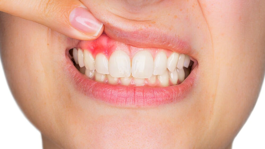 Ist Gingivitis ansteckend? Wissenschaftliche Fakten über die Übertragung von Zahnfleischerkrankungen